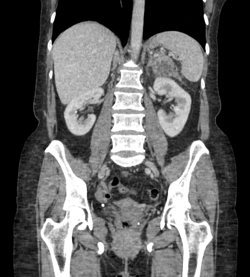 Acute pancreatitis - Balthazar E - post ERCP (Radiopaedia 27562-27772 Coronal C+ portal venous phase 53).png