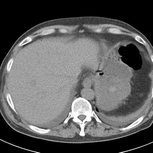 File:Acute pancreatitis and walled-off necrosis (Radiopaedia 29888-30403 Axial non-contrast 9).jpg