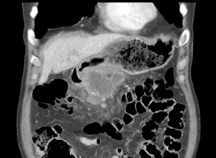 Acute pancreatitis and walled-off necrosis (Radiopaedia 29888-30404 Coronal C+ portal venous phase 14).jpg