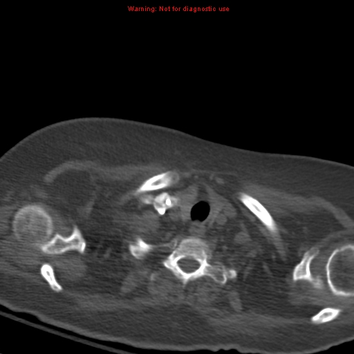 File:Acute pulmonary embolism (Radiopaedia 13286-13289 Axial C+ CTPA 5).jpg