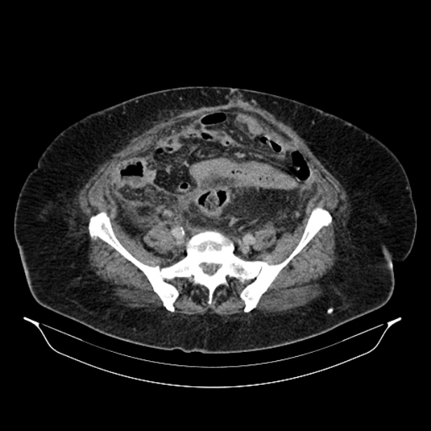 Acute pyelonephritis (Radiopaedia 25657-25837 Axial renal parenchymal phase 58).jpg