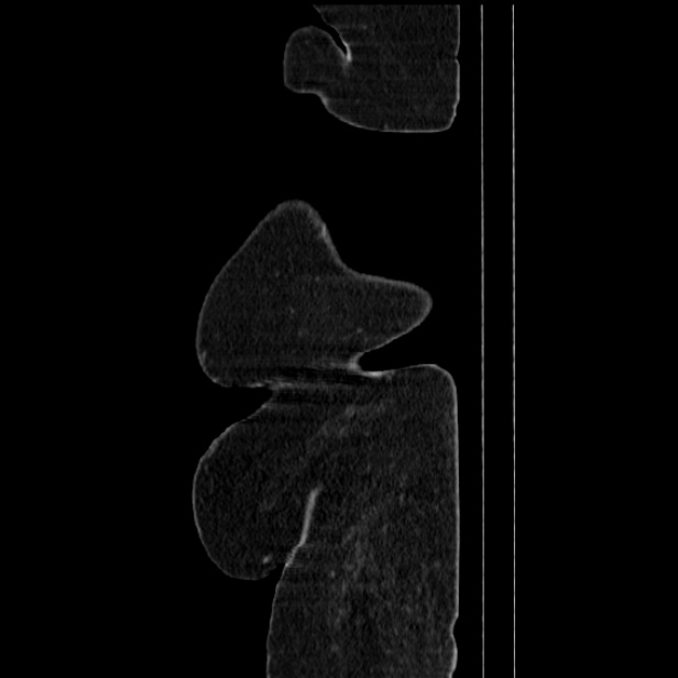 Acute pyelonephritis (Radiopaedia 25657-25837 Sagittal renal parenchymal phase 78).jpg