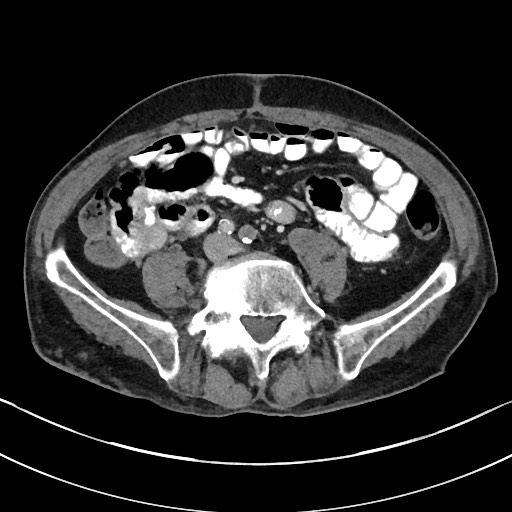 Acute renal infarction - rim capsular enhancement (Radiopaedia 59833-67270 Axial C+ portal venous phase 62).jpg