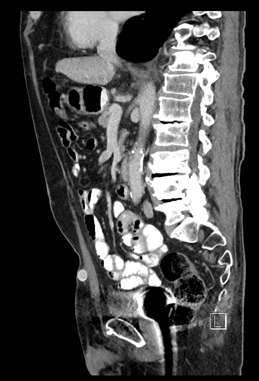 Acute renal infarction - rim capsular enhancement (Radiopaedia 59833-67270 Sagittal C+ portal venous phase 51).jpg