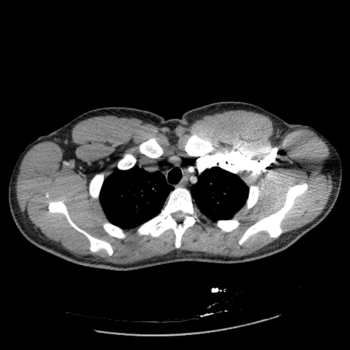 Acute segmental pulmonary emboli and pulmonary infarction (Radiopaedia 62264-70444 Axial C+ CTPA 24).jpg