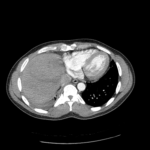 Acute segmental pulmonary emboli and pulmonary infarction (Radiopaedia 62264-70444 Axial C+ CTPA 88).jpg