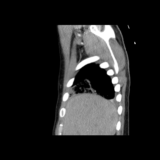 Acute segmental pulmonary emboli and pulmonary infarction (Radiopaedia 62264-70444 Sagittal C+ CTPA 11).jpg