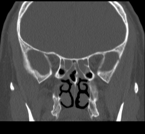 Acute sinusitis (Radiopaedia 23161-23215 Coronal bone window 43).jpg