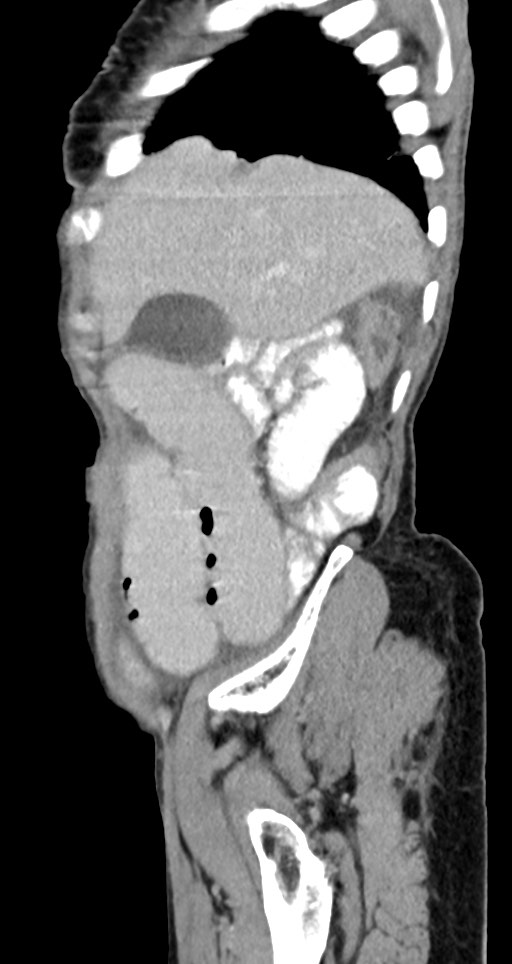 Acute small bowel (ileal) volvulus (Radiopaedia 71740-82139 Sagittal C+ portal venous phase 133).jpg