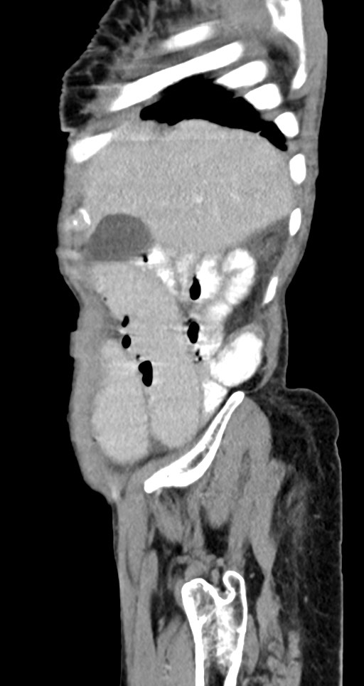 Acute small bowel (ileal) volvulus (Radiopaedia 71740-82139 Sagittal C+ portal venous phase 137).jpg