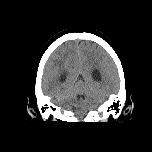 Acute subarachnoid hemorrhage and accessory anterior cerebral artery (Radiopaedia 69231-79008 Coronal non-contrast 50).jpg