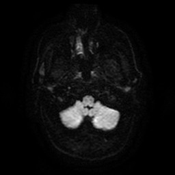 File:Acute superior cerebellar artery territory infarct (Radiopaedia 84104-99358 Axial DWI 62).jpg