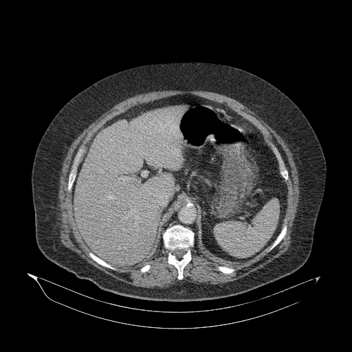 Acute superior mesenteric artery occlusion (Radiopaedia 51288-56960 Axial C+ portal venous phase 27).jpg