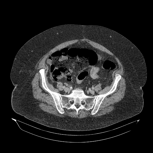 Acute superior mesenteric artery occlusion (Radiopaedia 51288-56960 Axial C+ portal venous phase 77).jpg