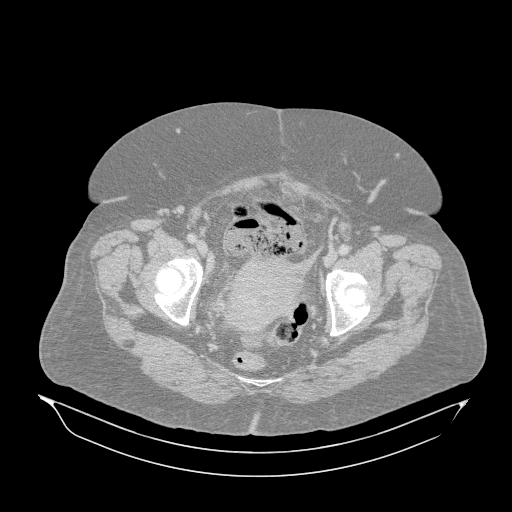 File:Acute superior mesenteric artery occlusion (Radiopaedia 51288-56960 Axial lung window 71).jpg