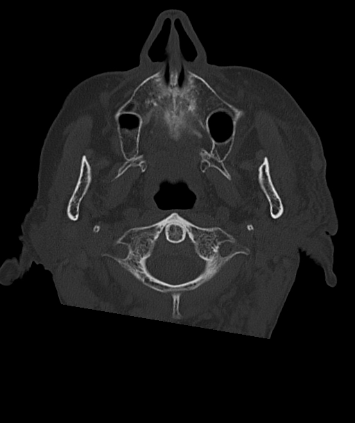 Acute traumatic subdural hematoma (Radiopaedia 82921-97257 Axial bone window 103).jpg