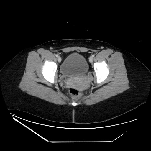 Acute uncomplicated appendicitis (Radiopaedia 73704-84499 Axial C+ portal venous phase 149).jpg