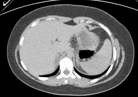 Acute unilateral nonhemorrhagic adrenal infarction (Radiopaedia 67560-76957 Axial renal excretory phase 13).jpg