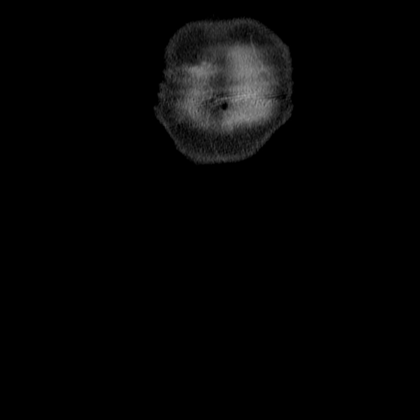 Adenocarcinoma of colon with entero-colic fistula (Radiopaedia 22832-22852 Coronal C+ portal venous phase 2).jpg