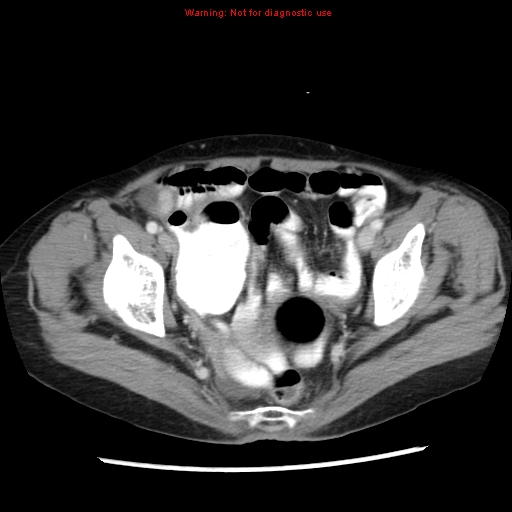 File:Adenocarcinoma of the colon (Radiopaedia 8191-9039 Axial liver window 66).jpg