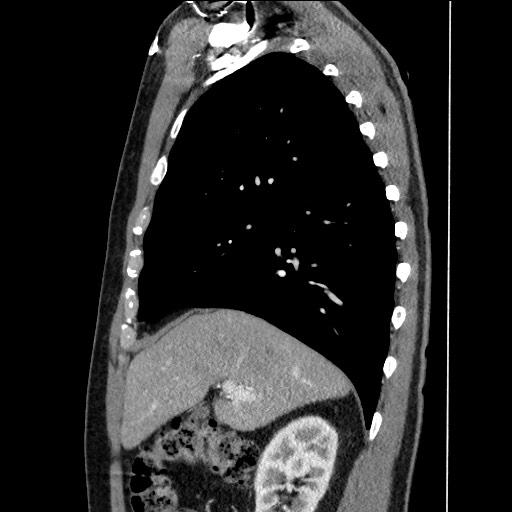 Adenocarcinoma of the lung (Radiopaedia 59871-67325 Sagittal C+ arterial phase 29).jpg