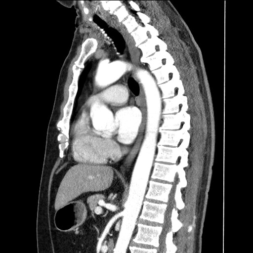 Adenocarcinoma of the lung (Radiopaedia 59871-67325 Sagittal C+ arterial phase 54).jpg
