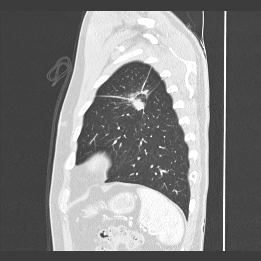 Adenocarcinoma of the lung (Radiopaedia 59871-67325 Sagittal lung window 85).jpg