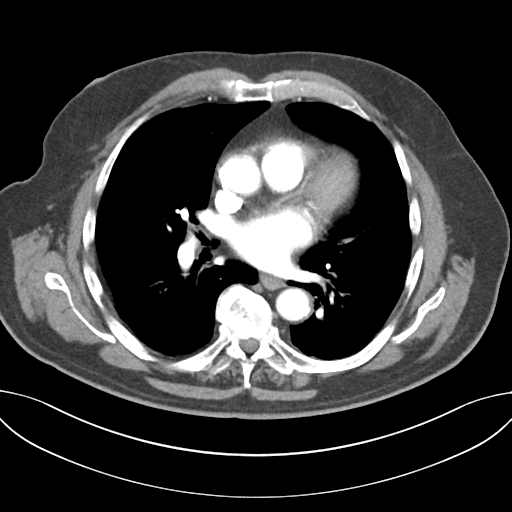 Adenocarcioma of rectum- T1 lesion (Radiopaedia 36921-38547 Axial C+ arterial phase 31).png