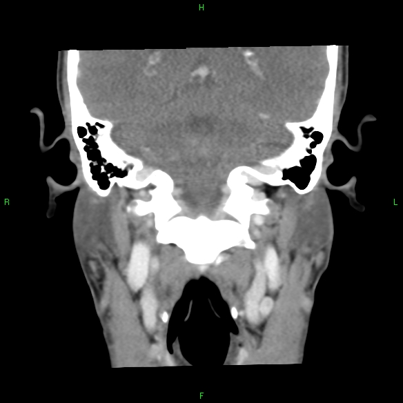 File:Adenoid cystic carcinoma of hard palate (Radiopaedia 26137-26273 Coronal liver window 27).jpg