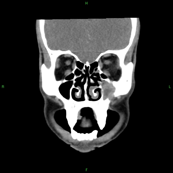 File:Adenoid cystic carcinoma of hard palate (Radiopaedia 26137-26273 Coronal liver window 7).jpg