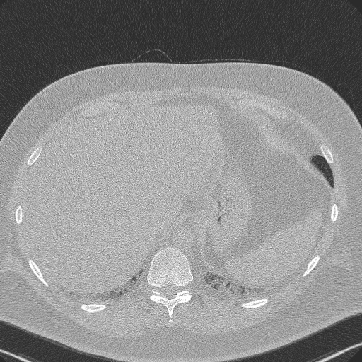 Adenoid cystic carcinoma of the trachea (Radiopaedia 49042-54137 Axial lung window 308).jpg