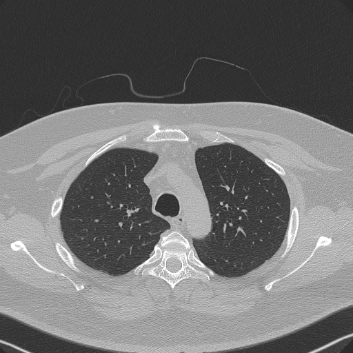 Adenoid cystic carcinoma of the trachea (Radiopaedia 49042-54137 Axial lung window 90).jpg