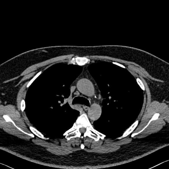 File:Adenoid cystic carcinoma of the trachea (Radiopaedia 49042-54137 Axial non-contrast 115).jpg