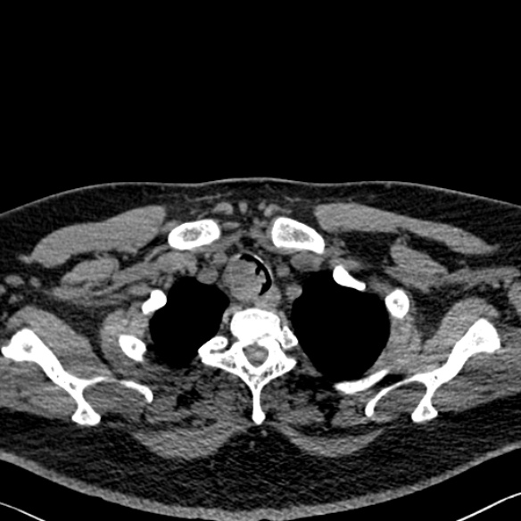 Adenoid cystic carcinoma of the trachea (Radiopaedia 49042-54137 Axial non-contrast 35).jpg