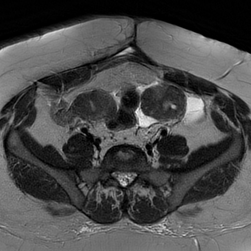 File:Adenomyosis within a didelphys uterus (Radiopaedia 70175-80215 Axial T2 8).jpg