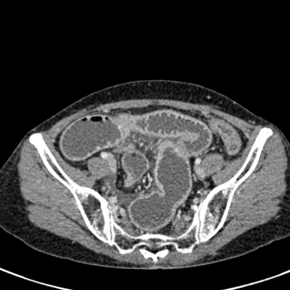 Adhesional small bowel obstruction (Radiopaedia 48397-53305 Axial C+ portal venous phase 72).jpg