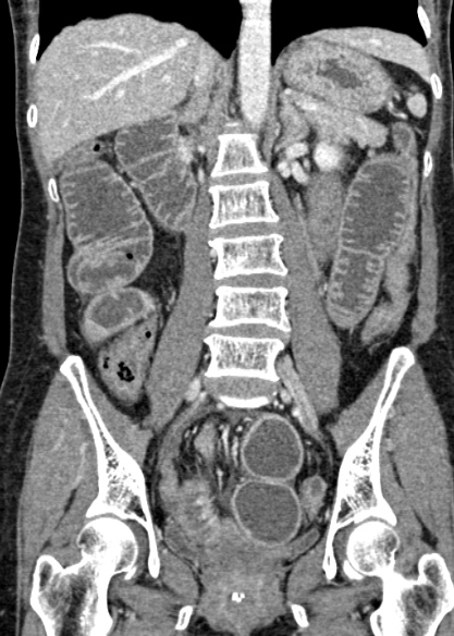 Adhesional small bowel obstruction (Radiopaedia 48397-53305 Coronal C+ portal venous phase 206).jpg