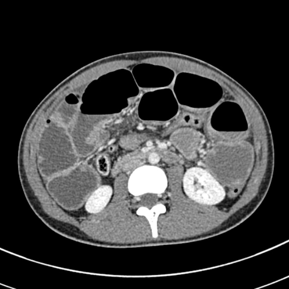 Adhesional small bowel obstruction (Radiopaedia 52107-57980 Axial C+ portal venous phase 54).jpg