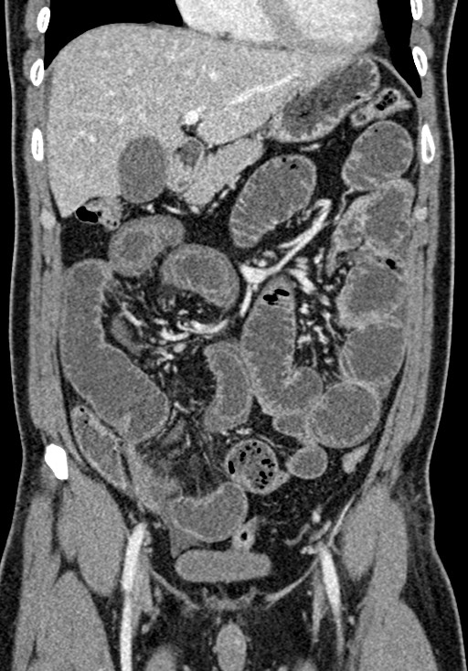 Adhesional small bowel obstruction (Radiopaedia 58900-66131 Coronal C+ portal venous phase 112).jpg