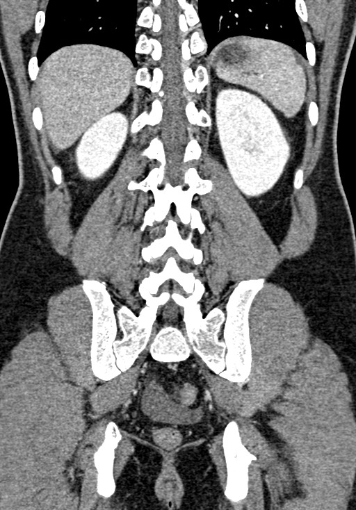 Adhesional small bowel obstruction (Radiopaedia 58900-66131 Coronal C+ portal venous phase 192).jpg
