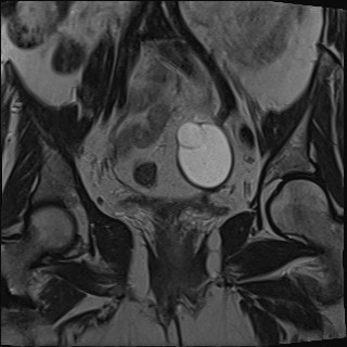 File:Adnexal multilocular cyst (O-RADS US 3- O-RADS MRI 3) (Radiopaedia 87426-103754 Coronal T2 17).jpg