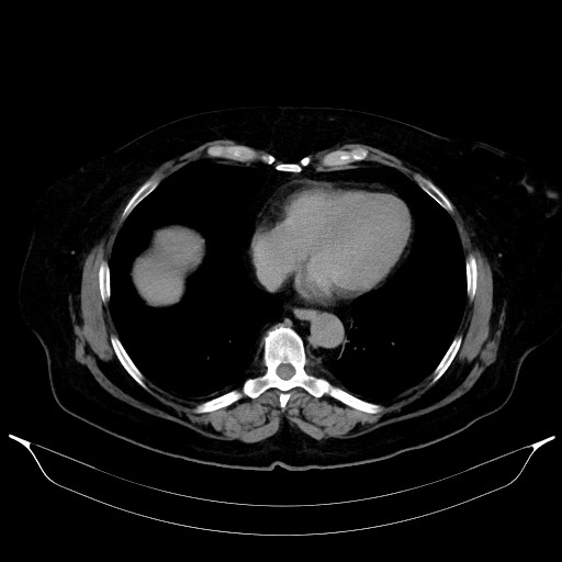 Adrenal cortical carcinoma (Radiopaedia 64017-72769 Axial C+ delayed 5).jpg