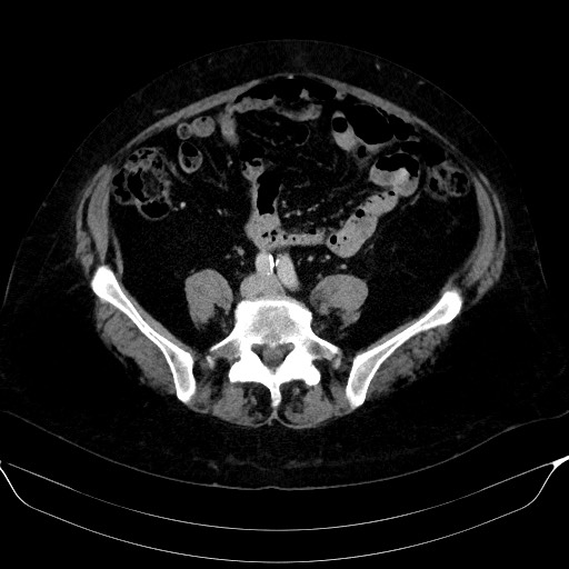 File:Adrenal cortical carcinoma (Radiopaedia 64017-72769 Axial C+ portal venous phase 48).jpg