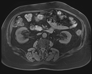 Adrenal cortical carcinoma (Radiopaedia 64017-72770 Axial T1 fat sat 48).jpg