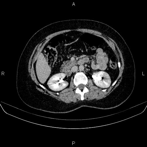 Adrenal cortical carcinoma (Radiopaedia 84882-100379 Axial C+ delayed 36).jpg