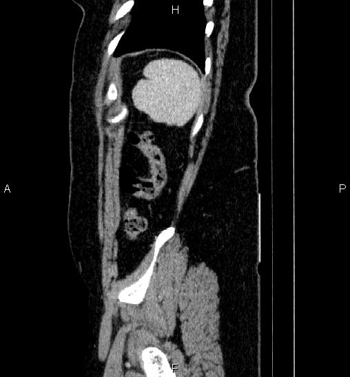 Adrenal cortical carcinoma (Radiopaedia 84882-100379 Sagittal C+ portal venous phase 78).jpg