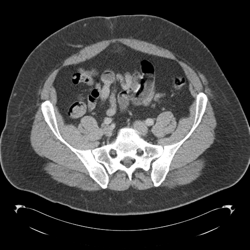 Adrenal cyst (Radiopaedia 45625-49776 Axial C+ portal venous phase 72).png