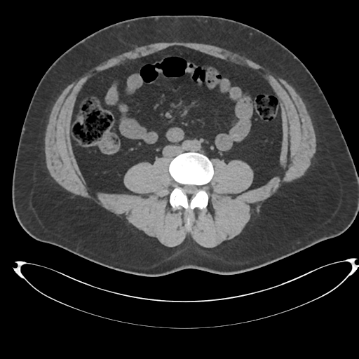 Adrenal cyst (Radiopaedia 45625-49778 Axial non-contrast 77).png