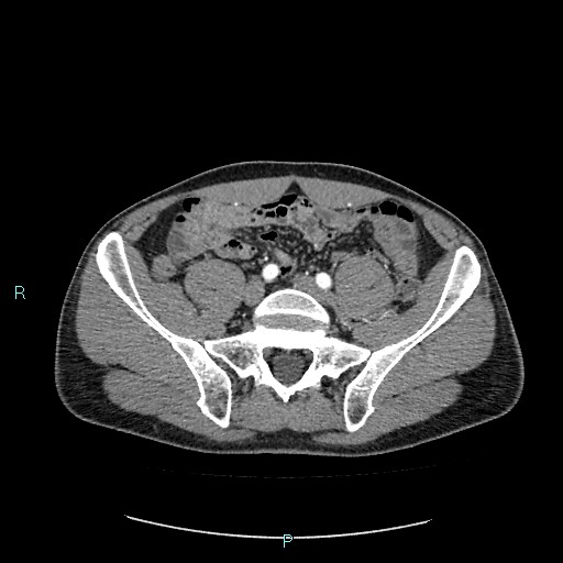 Adrenal cystic lymphangioma (Radiopaedia 83161-97534 Axial C+ arterial phase 70).jpg