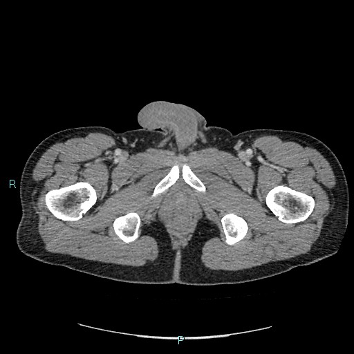 File:Adrenal cystic lymphangioma (Radiopaedia 83161-97534 Axial C+ portal venous phase 106).jpg